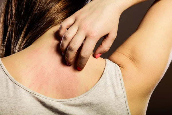 Understanding Skin Allergies: Causes and Treatments for Common Rashes