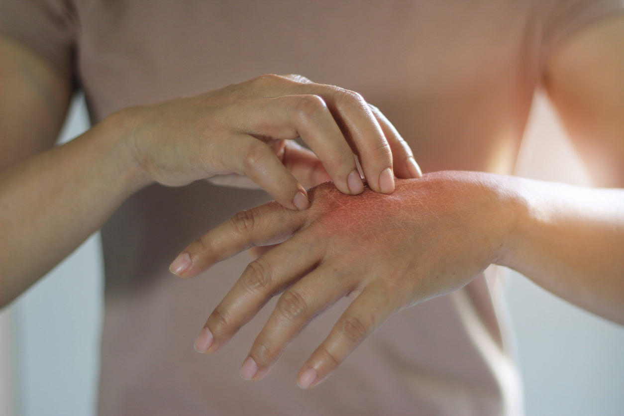 Deciphering the Contrast: Eczema vs. Psoriasis